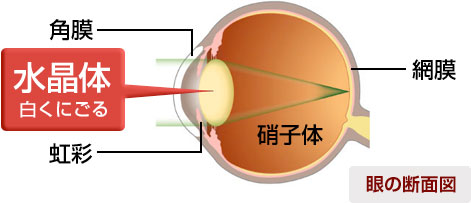 白内障原因