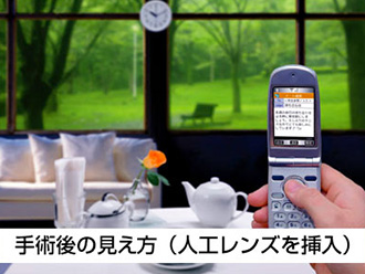 手術後の見え方