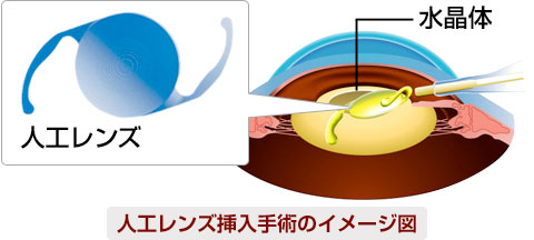 人工レンズ挿入手術イメージ